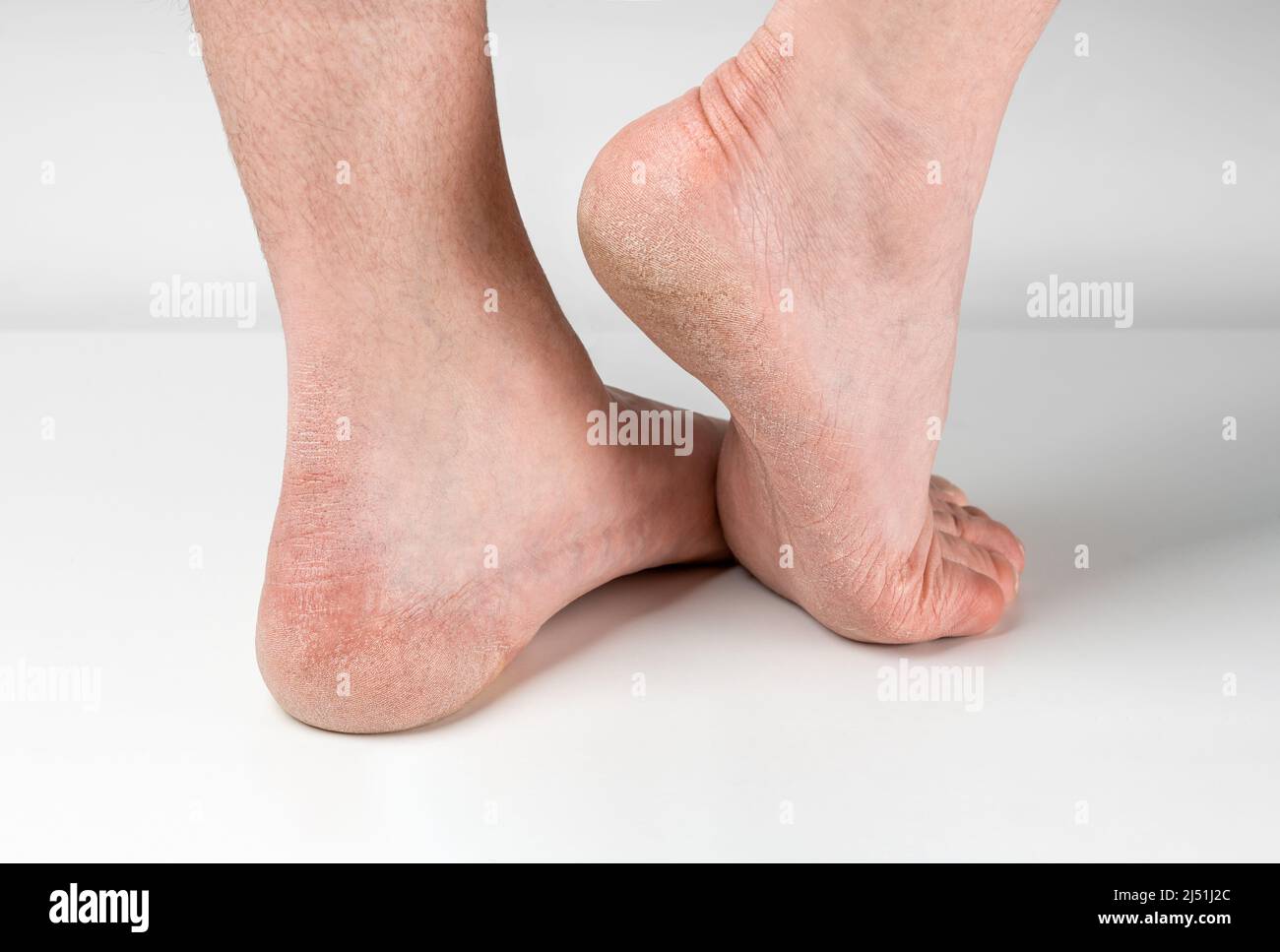 Suole di piedi asciutte e screpolate su sfondo bianco, piedi uomo con tacchi asciutti, pelle screpolata. Primo piano di crepe su tacchi con cattive pelle ricoperta. Healthcar Foto Stock