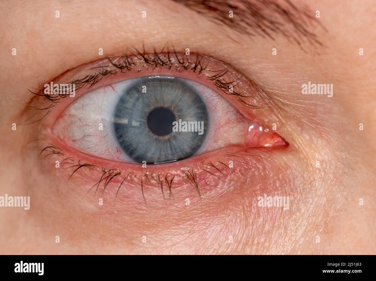 occhio infiammato rosso con lente a contatto, macrofotografia close-up. Dilatazione dei vasi sanguigni dell'occhio, sforzo dal calcolatore. Trattamento dell'occhio secco e irritato Foto Stock