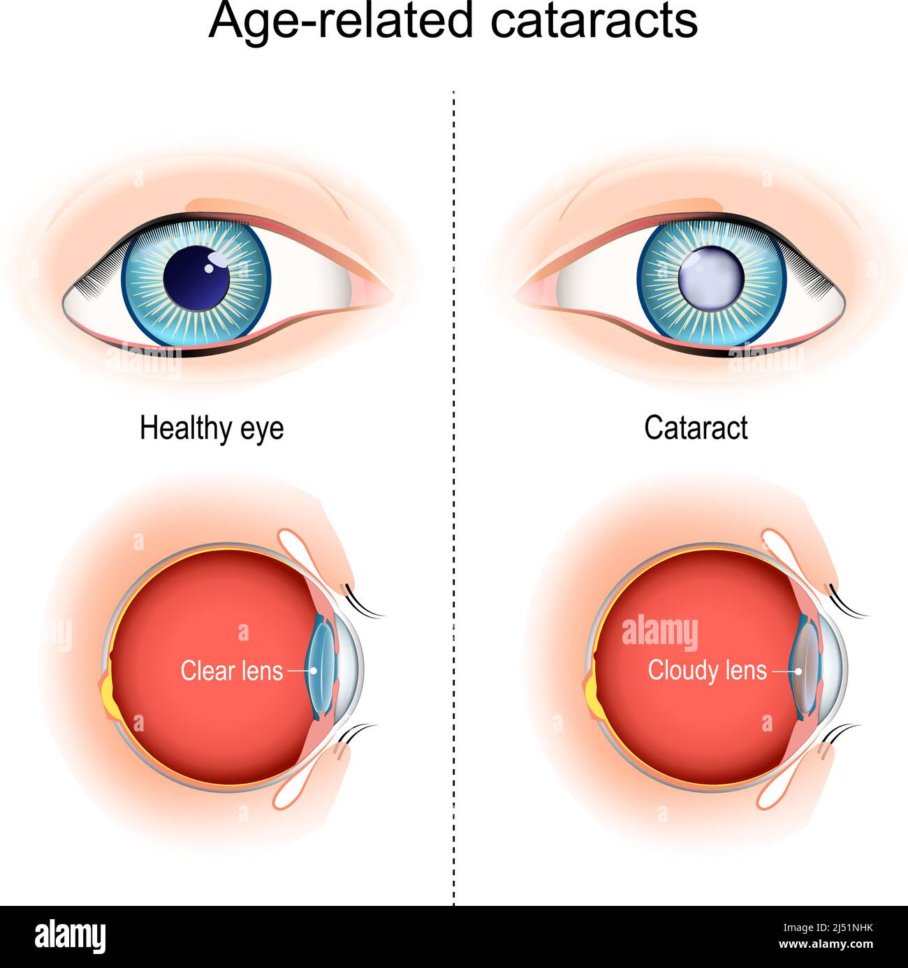 cataratte. Problemi di visione legati all'età. Vista in sezione, che mostra la posizione della lente umana. Illustrazione vettoriale Illustrazione Vettoriale