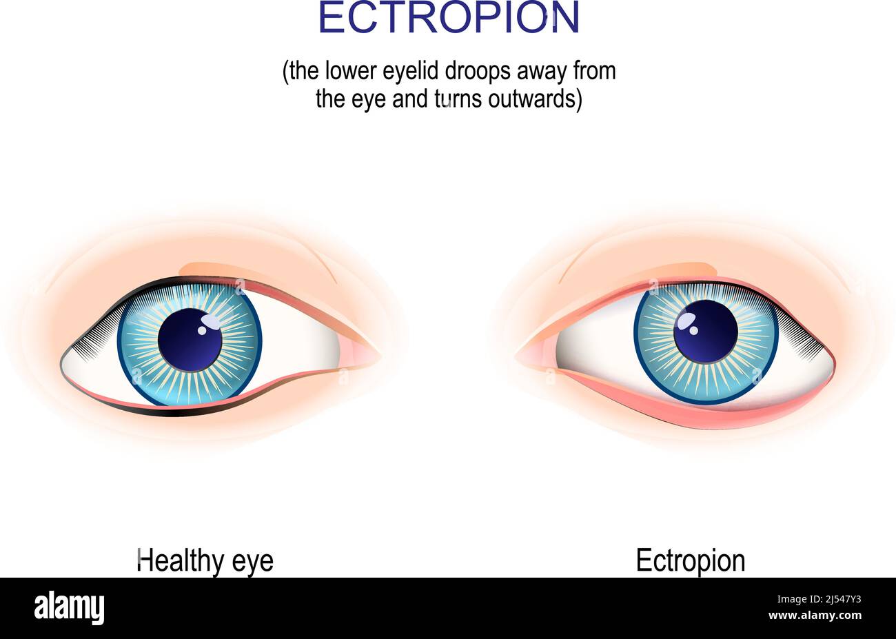 Spectropion. La palpebra inferiore si allontana dall'occhio e si gira verso l'esterno. Esame medico. Illustrazione vettoriale Illustrazione Vettoriale