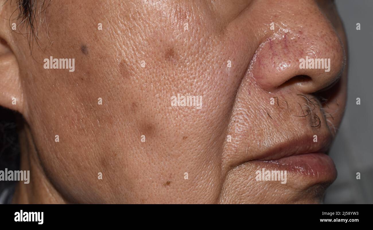 Piccole macchie marroni chiamate macchie di età sulla faccia dell'anziano asiatico. Sono anche chiamati macchie di fegato, lentigo senile, o macchie di sole. Primo piano. Foto Stock