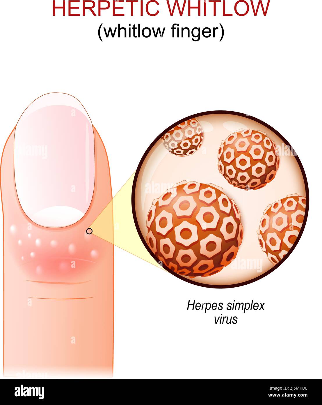 whitlow erpetico. whitlow dito. Dito umano con malattia della pelle. Primo piano di virioni del virus Herpes simplex. Illustrazione vettoriale Illustrazione Vettoriale