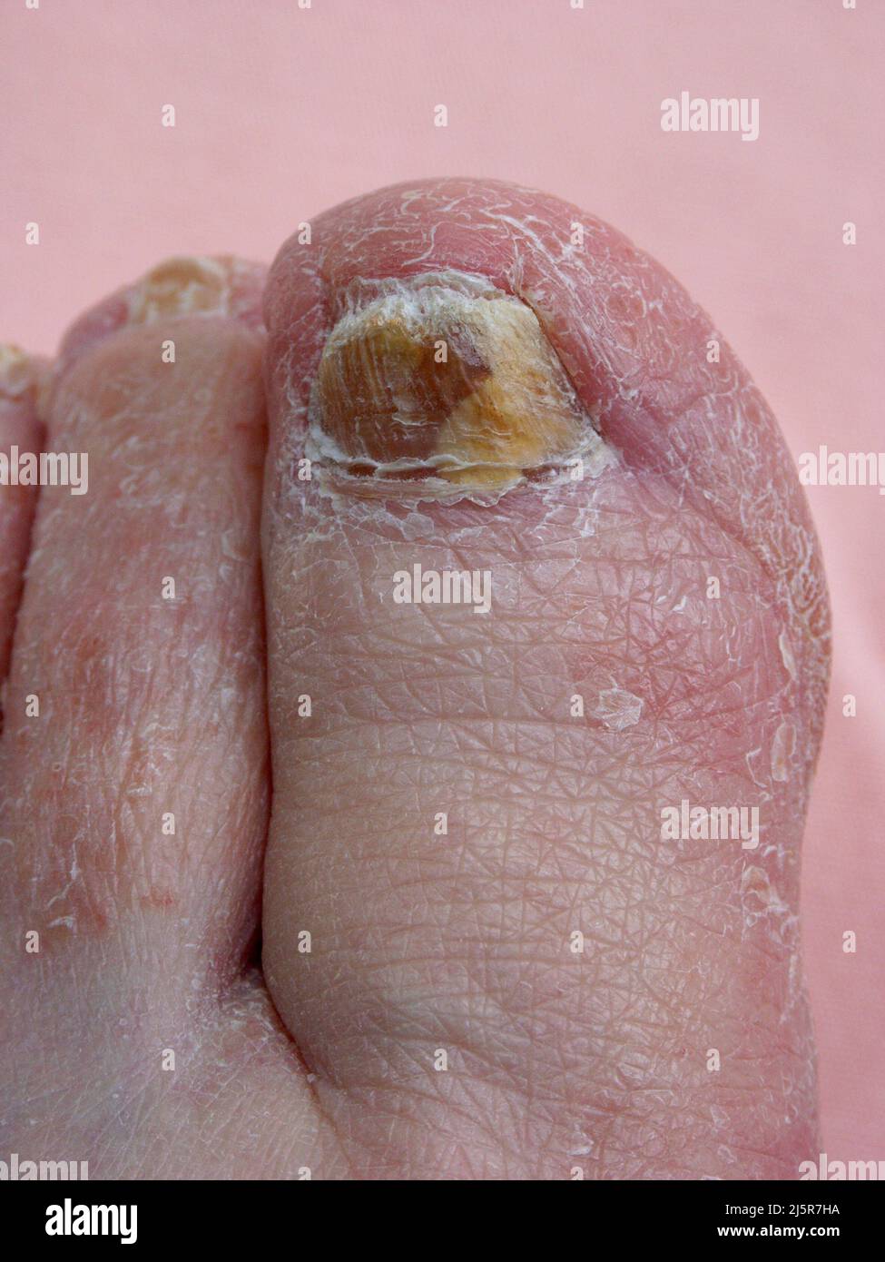 Infezione fungina da unghia, Onicomicosi, Stock Photo of Yellow Nails toenails spesse, infette, unghie fragili, Fungo, piedi caucasici Foto Stock