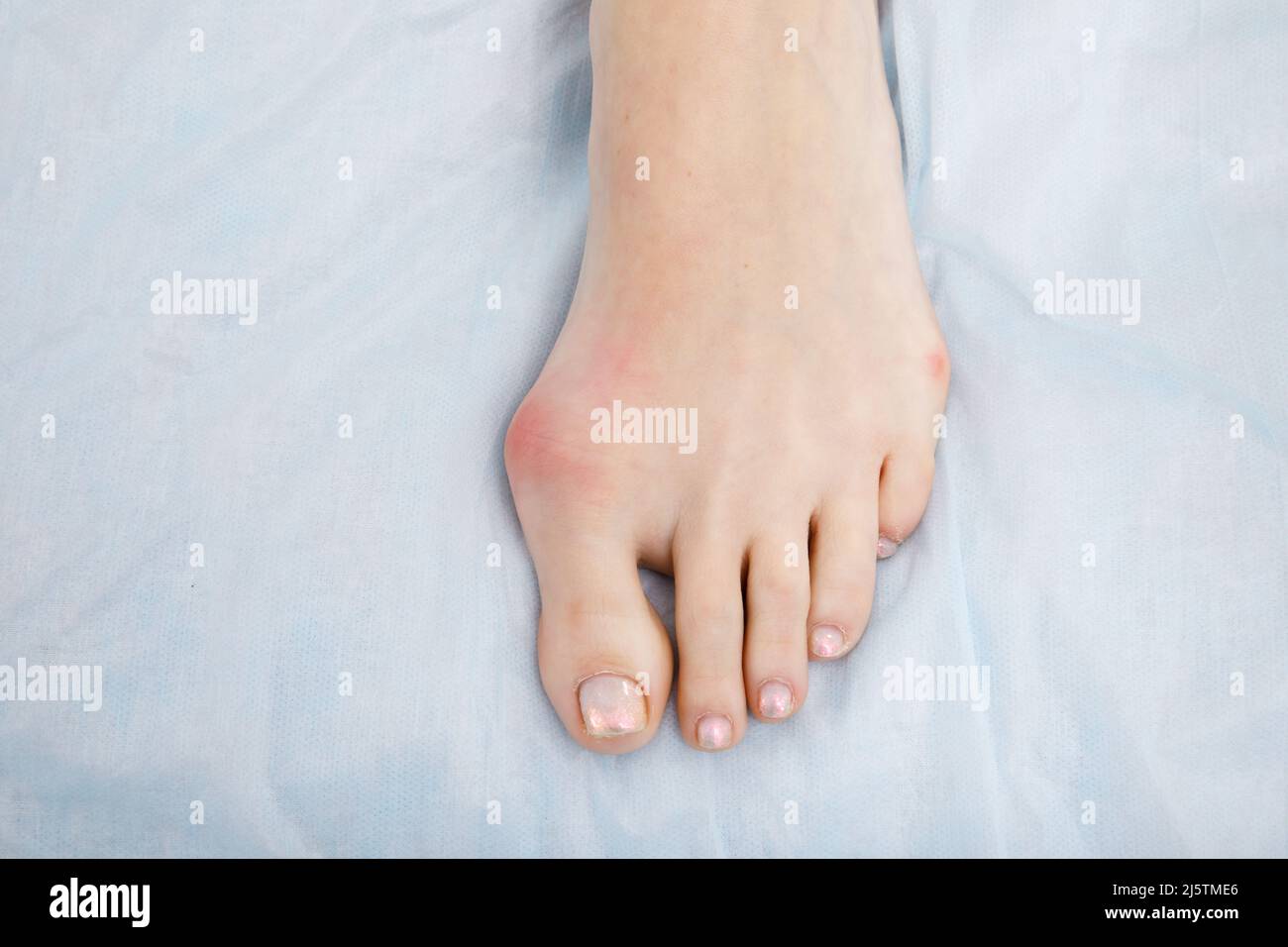 La donna soffre di infiammazione dell'osso del grande dito del piede. Allux valgus, bunion a piedi su sfondo bianco. Foto Stock