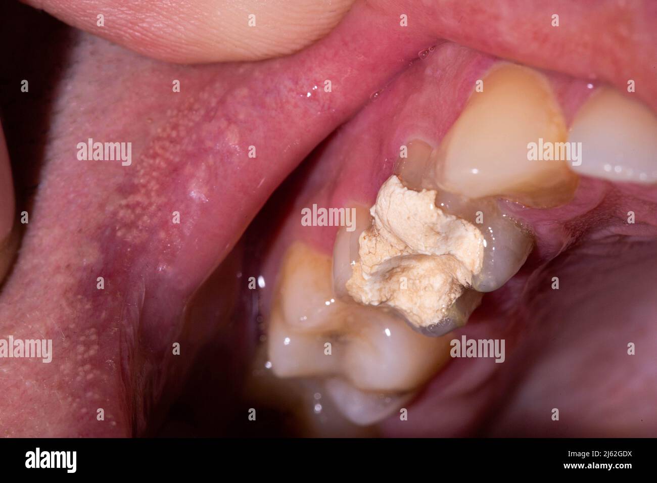 Riempimento dei denti con cemento temporaneo per il trattamento del canale  radicolare. Rimozione dei nervi dentali, preparazione per protesi Foto  stock - Alamy