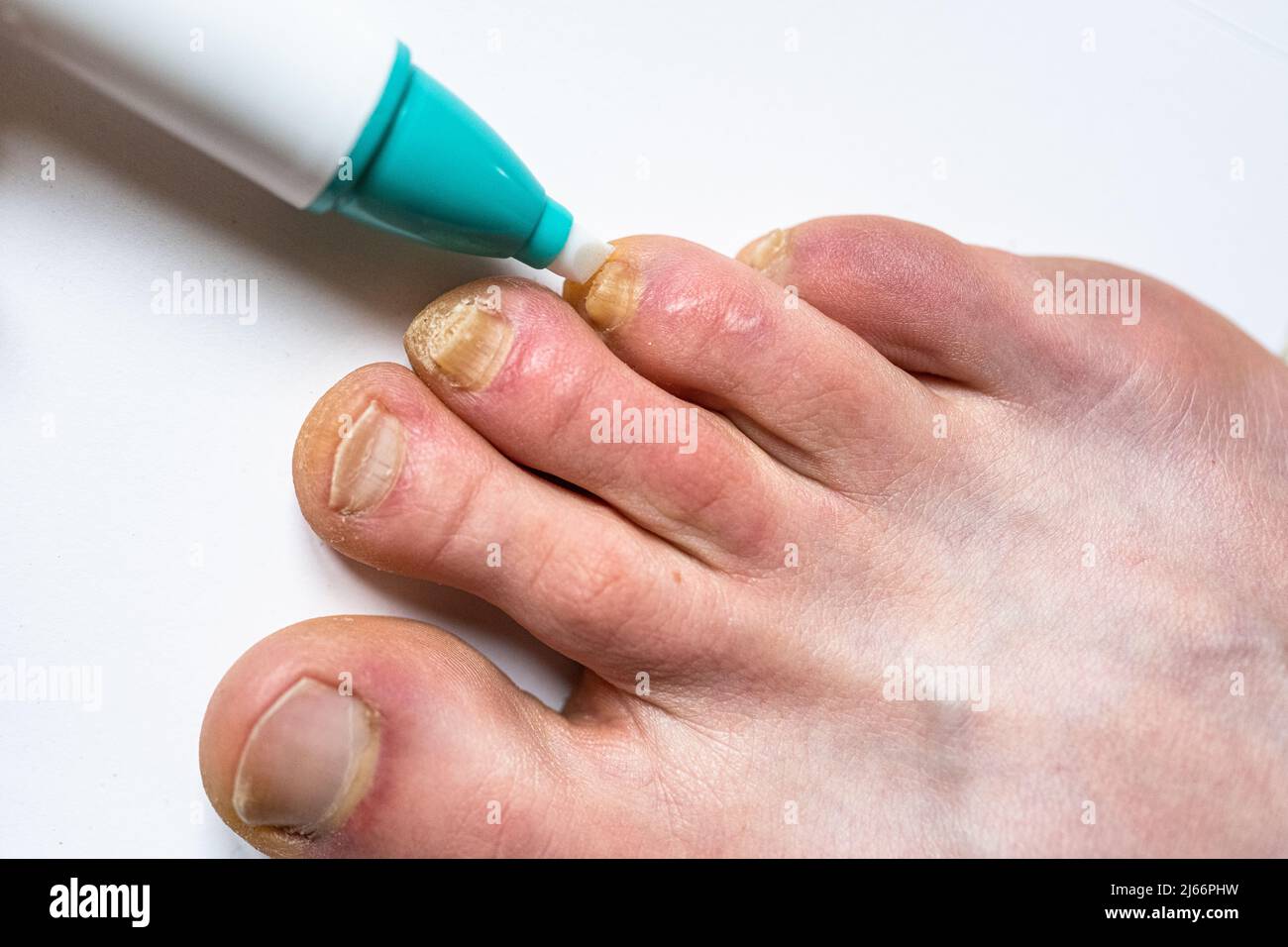 Usando una penna contro il fungo del chiodo. Trattamento delle infezioni fungine delle unghie. Foto Stock