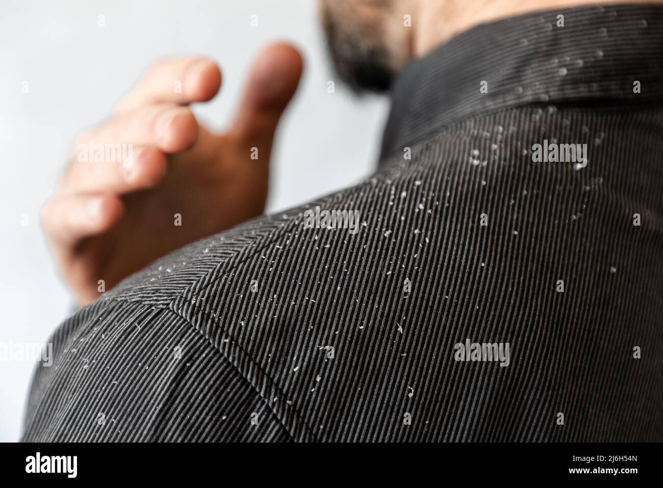 Un uomo barbuto in una camicia nera scuote il forforfora della sua spalla. Primo piano. Il concetto di psoriasi e dermatite seborroica. Foto Stock