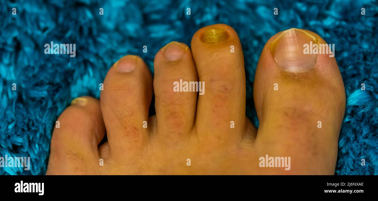 dita dei piedi in primo piano con un fungo infetto unghie, infezioni comuni e malattie Foto Stock