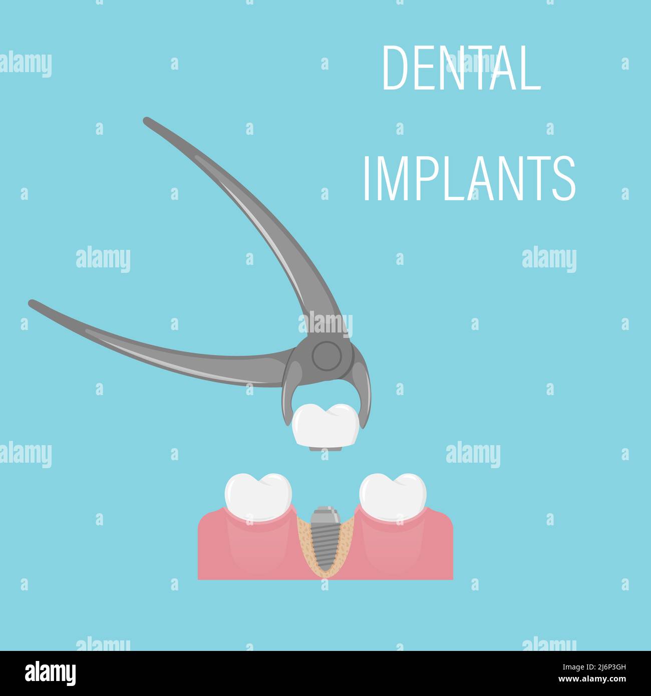 Installazione di impianti dentali. Odontoiatria estetica, medicina moderna. Corona di impianto in pinzette. Una vite nella gomma con un osso. Restauro del dentista Illustrazione Vettoriale