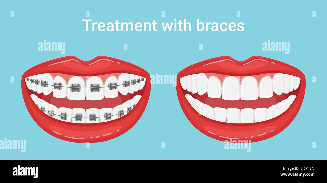Denti in bocca con o senza bretelle. Durante e dopo il trattamento  ortodontico. L'allineamento dei denti. Stile di vita sano e cura dentale.  Whit Immagine e Vettoriale - Alamy
