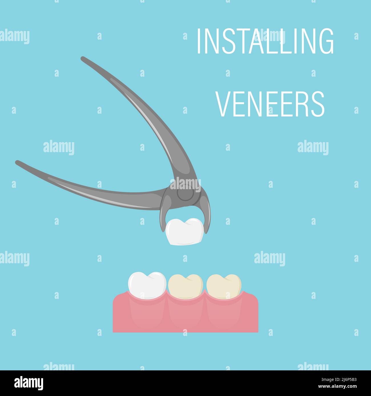 L'installazione del piallaccio. Alternativa alla sbianca. Procedura dentale cosmetica, odontoiatria estetica, medicina moderna. Inserti in pinzette. Semplice Illustrazione Vettoriale