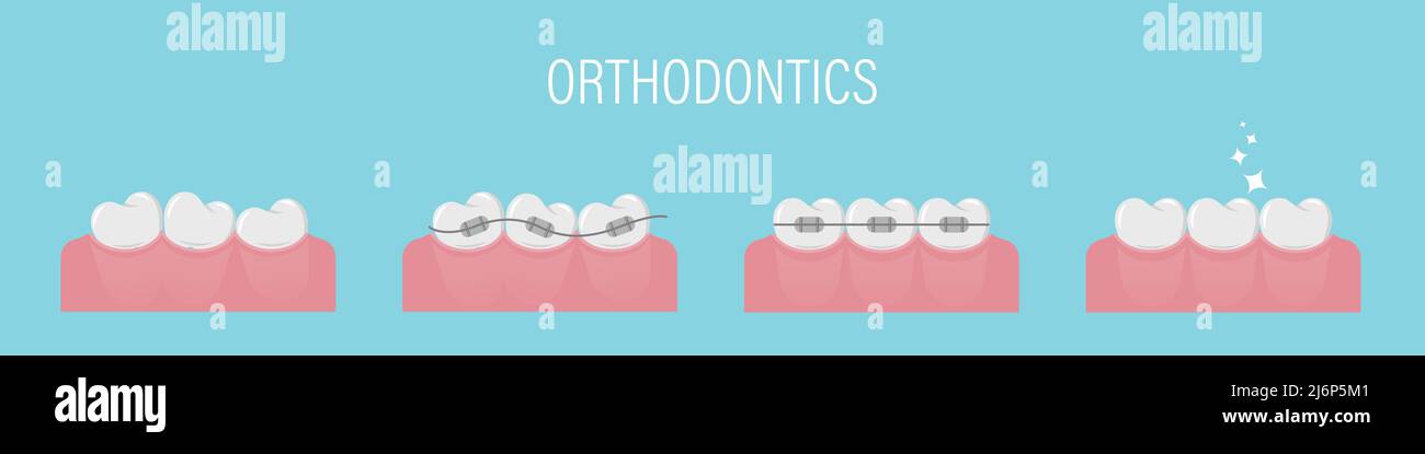 Il concetto di allineamento dei denti con i rinforzi. Poster con denti storto, in bretelle e sano anche. Denti semplici in fila. Trattamento ortodontico. Isola Illustrazione Vettoriale