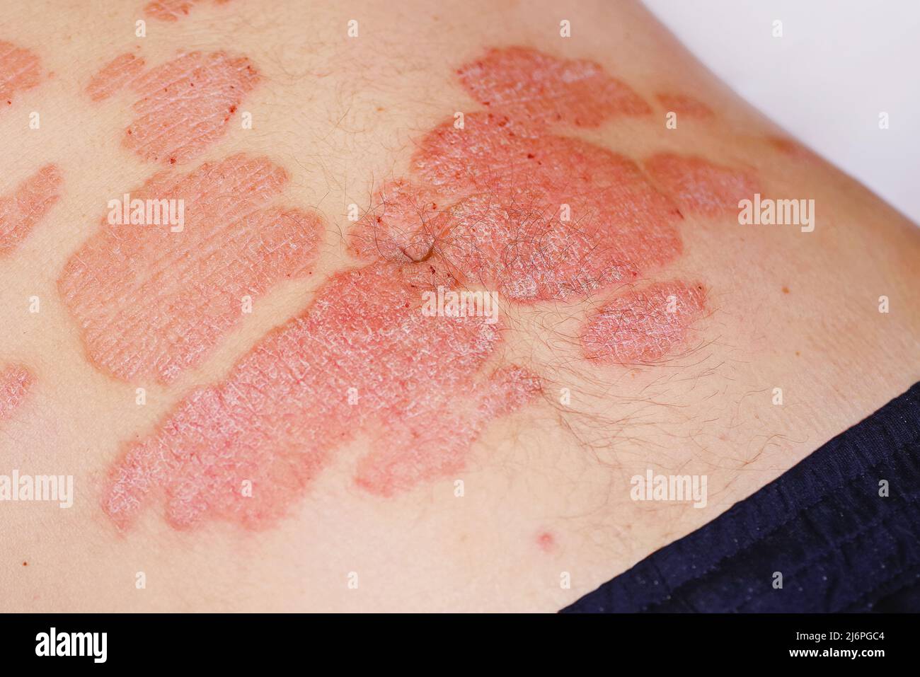 Psoriasi acuta allo stomaco in un uomo, grave arrossamento della pelle, una  malattia cutanea incurabile autoimmune. Rosso rossore, macchie sulla sk  Foto stock - Alamy