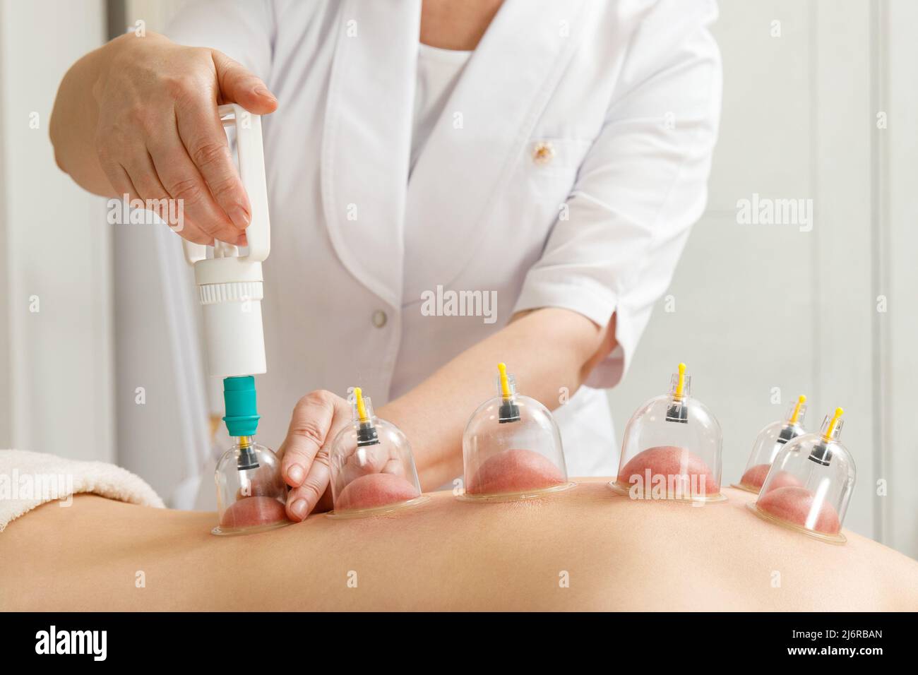 Massaggio sottovuoto. Coppe del vuoto di terapia medica di cupping sulla schiena della donna, primo piano, medicina cinese. Foto Stock