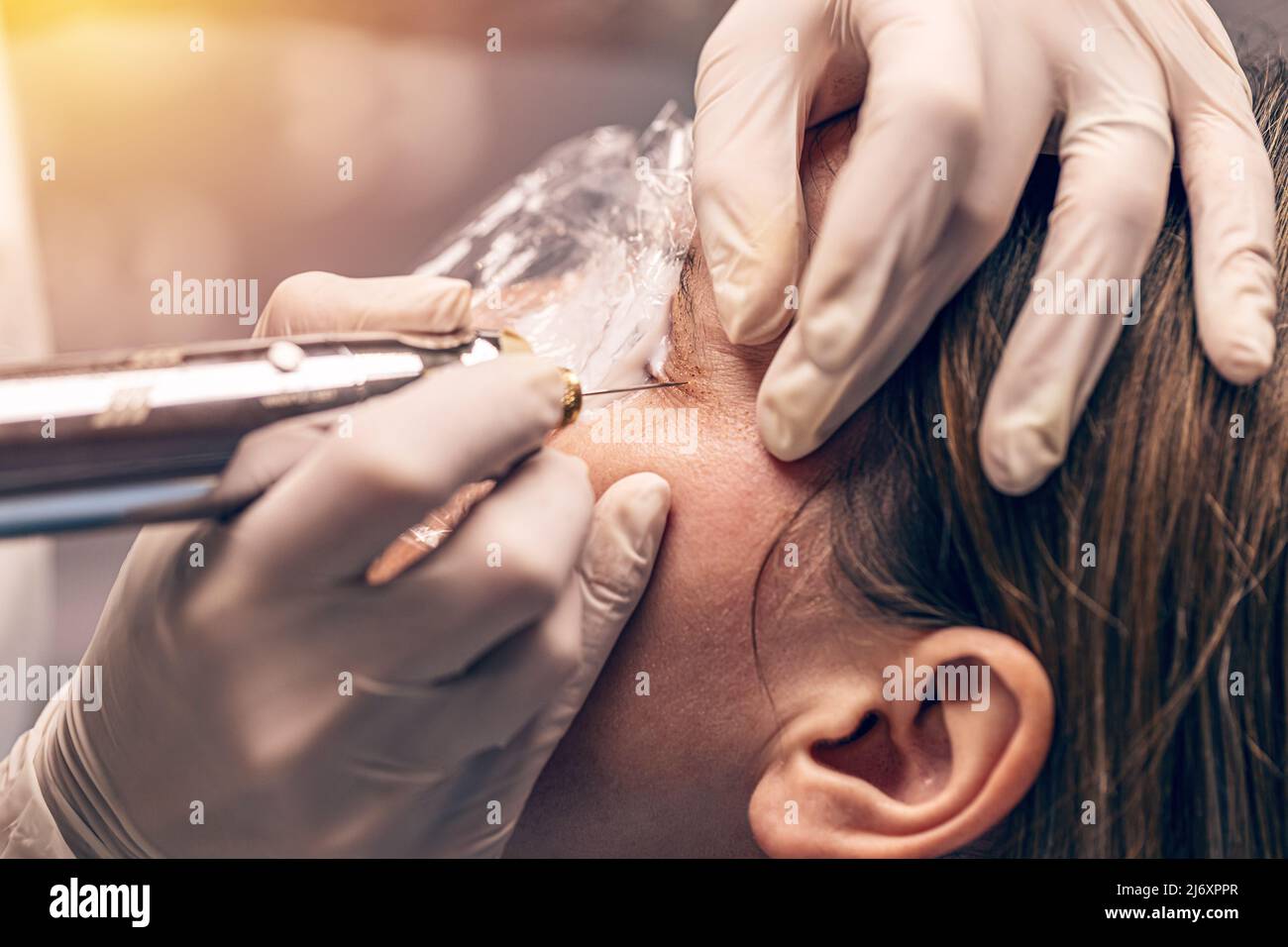 Sollevamento dell'occhio del plasma, trattamento anti-invecchiamento avanzato, comunemente noto come sollevamento della palpebra non chirurgico o blefaroplastica non invasiva Foto Stock