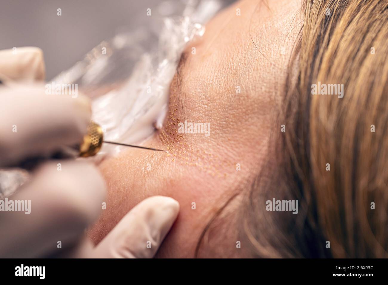 Donna sollevamento palpebre, procedura fibroblasti, trattamento di lusso plasma liner Foto Stock
