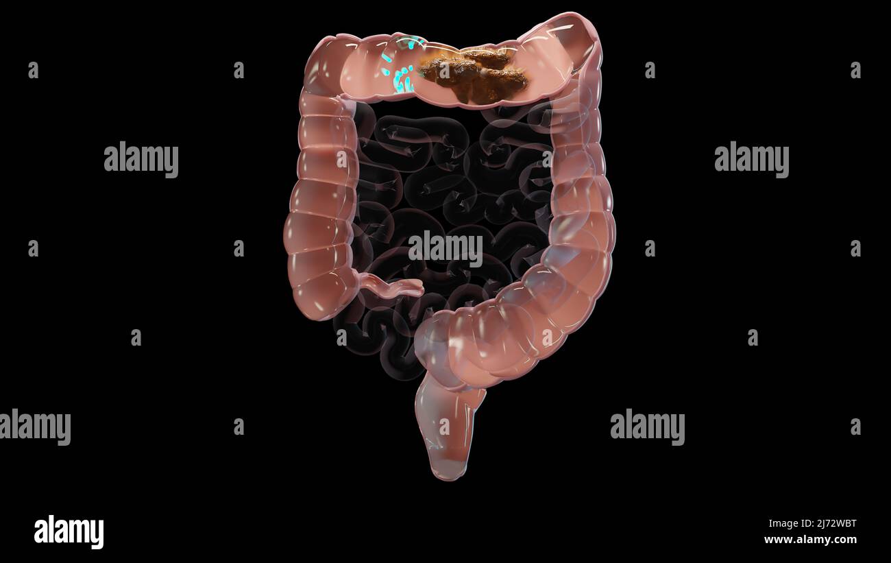3d illustrazione dell'anatomia umana del sistema digestivo, concetto dell'intestino, lassativo, traitement della costipazione, 3d resa Foto Stock