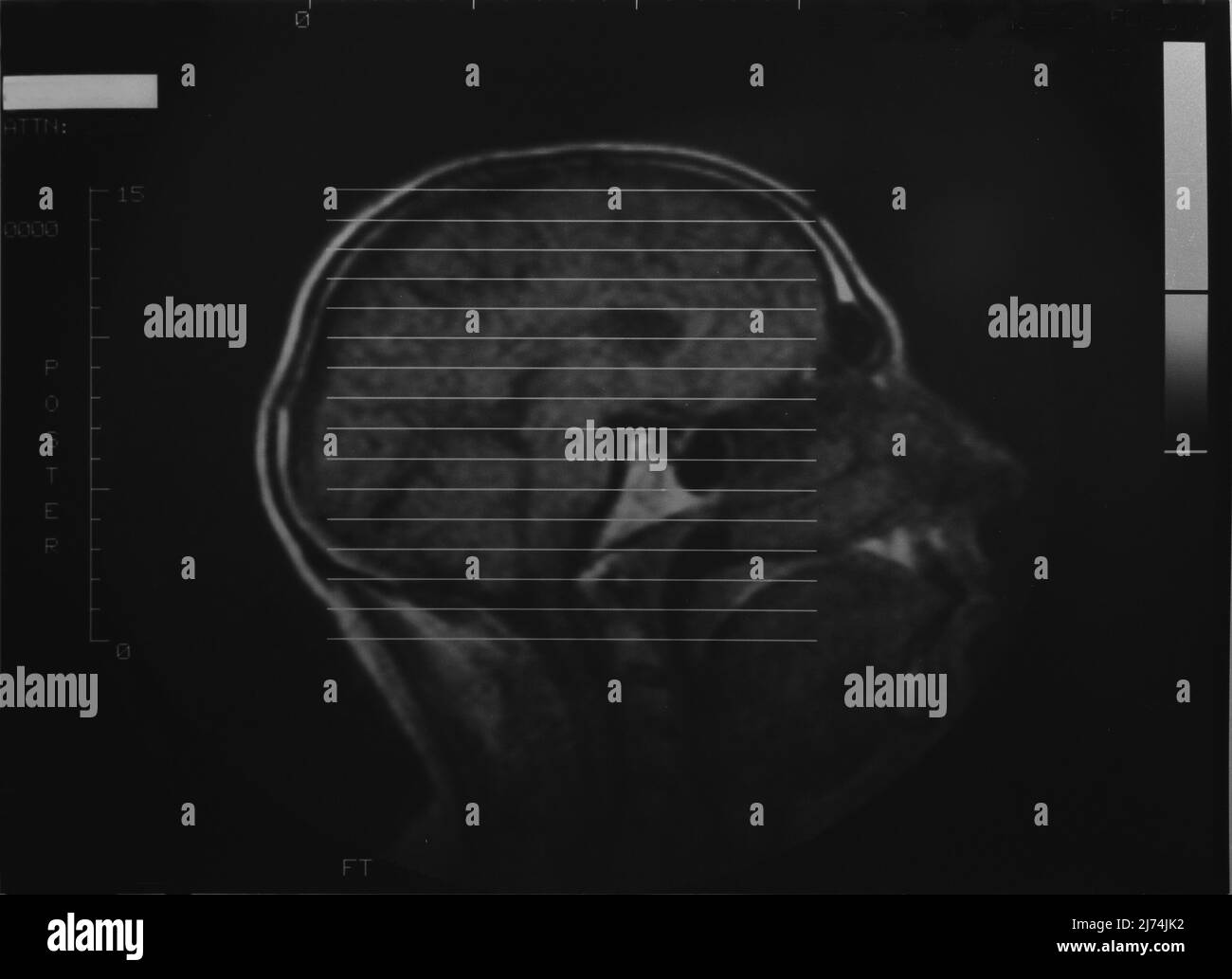 Röntgenbild eines Kopfes Foto Stock