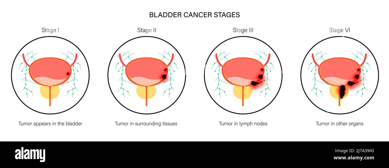 Stadi del cancro della vescica, illustrazione Foto Stock