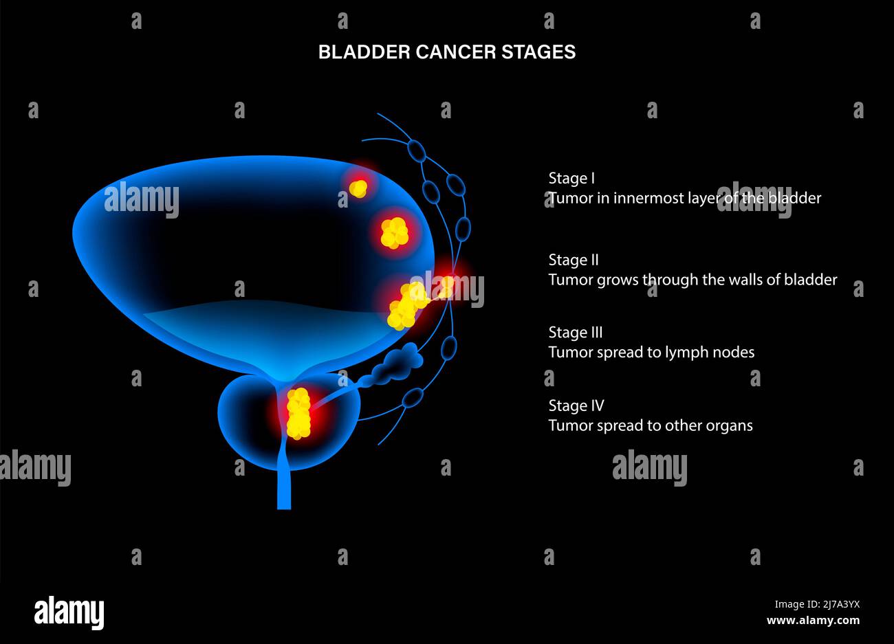 Stadi del cancro della vescica, illustrazione Foto Stock