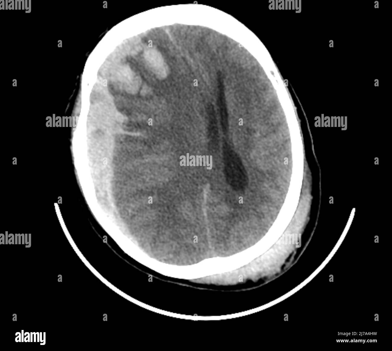 Lesioni cerebrali traumatiche, scansione TC Foto Stock