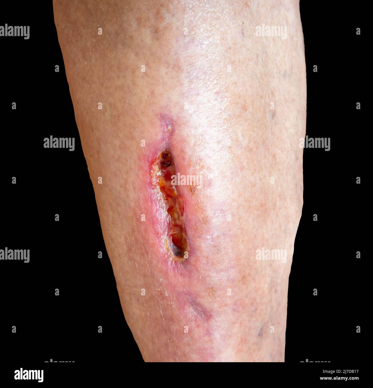 Ferita profonda di gaping sulla gamba dell'amante durante il trattamento medico dopo la ferita seria. Mancanza di pelle. Isolato su nero Foto Stock
