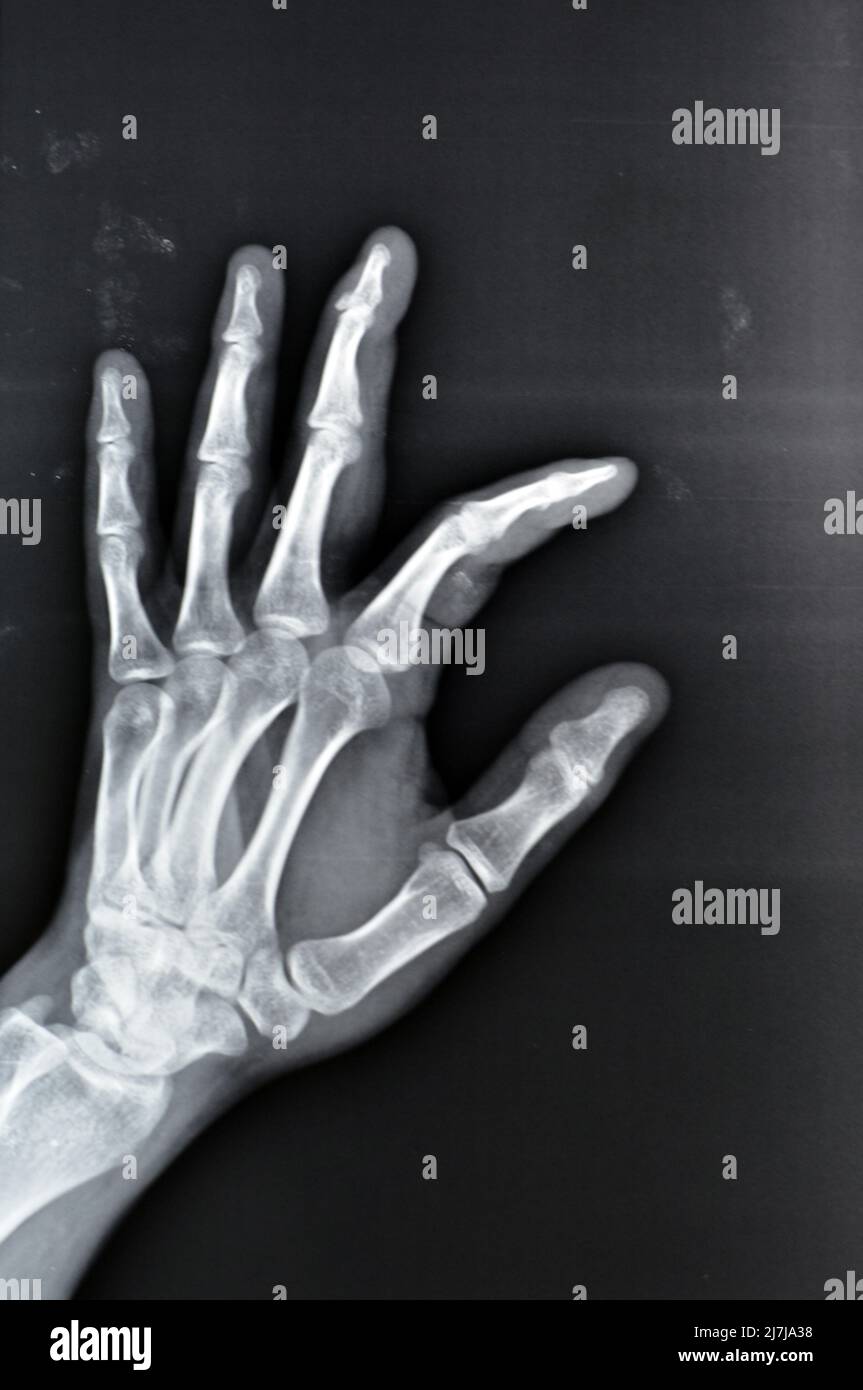 La radiografia piana mostra la base della frattura di avulsione della falanice distale del dito medio sinistro, la frattura di un piccolo pezzo di osso attaccato a un tendine o a Foto Stock