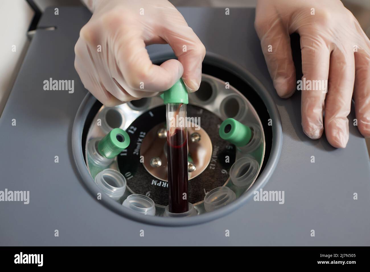 Preparazione del plasma ricco di piastrine. Plasma in siringa. Centrifugare Foto Stock