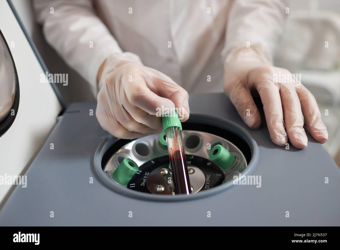 Preparazione del plasma ricco di piastrine. Plasma in siringa. Centrifugare Foto Stock