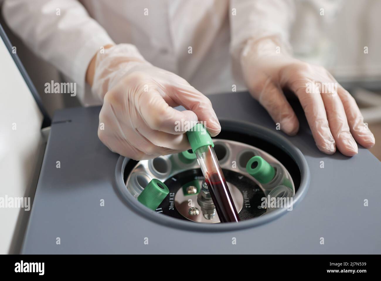 Preparazione del plasma ricco di piastrine. Plasma in siringa. Centrifugare Foto Stock