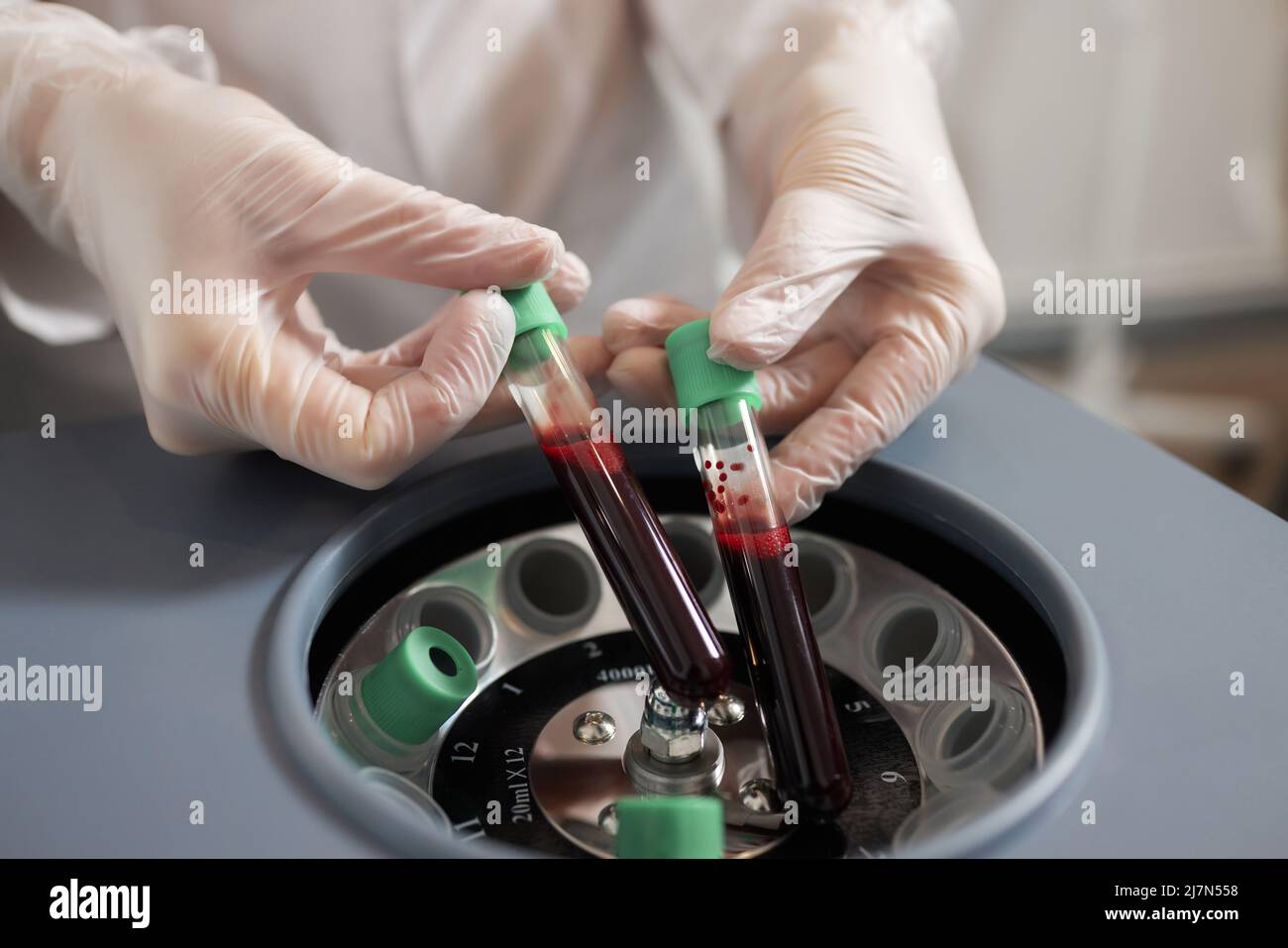 Preparazione del plasma ricco di piastrine. Plasma in siringa. Centrifugare Foto Stock