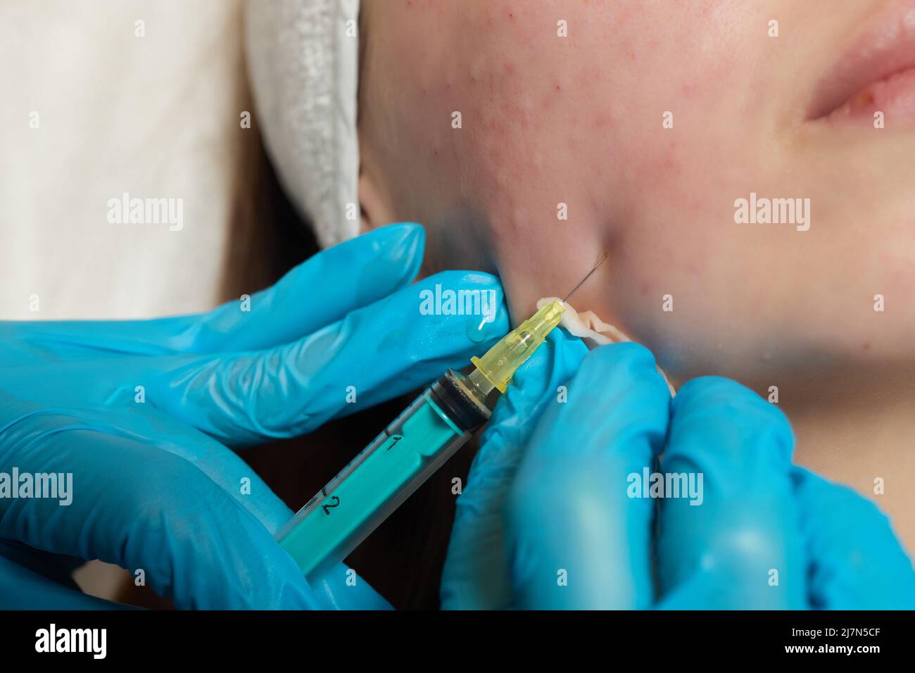 Siringa con plasma sanguigno di un paziente in una mano di un cosmetologo per un plasmolifting della pelle del viso di una donna. Plasma terapia, il ripristino delle cellule della pelle Foto Stock