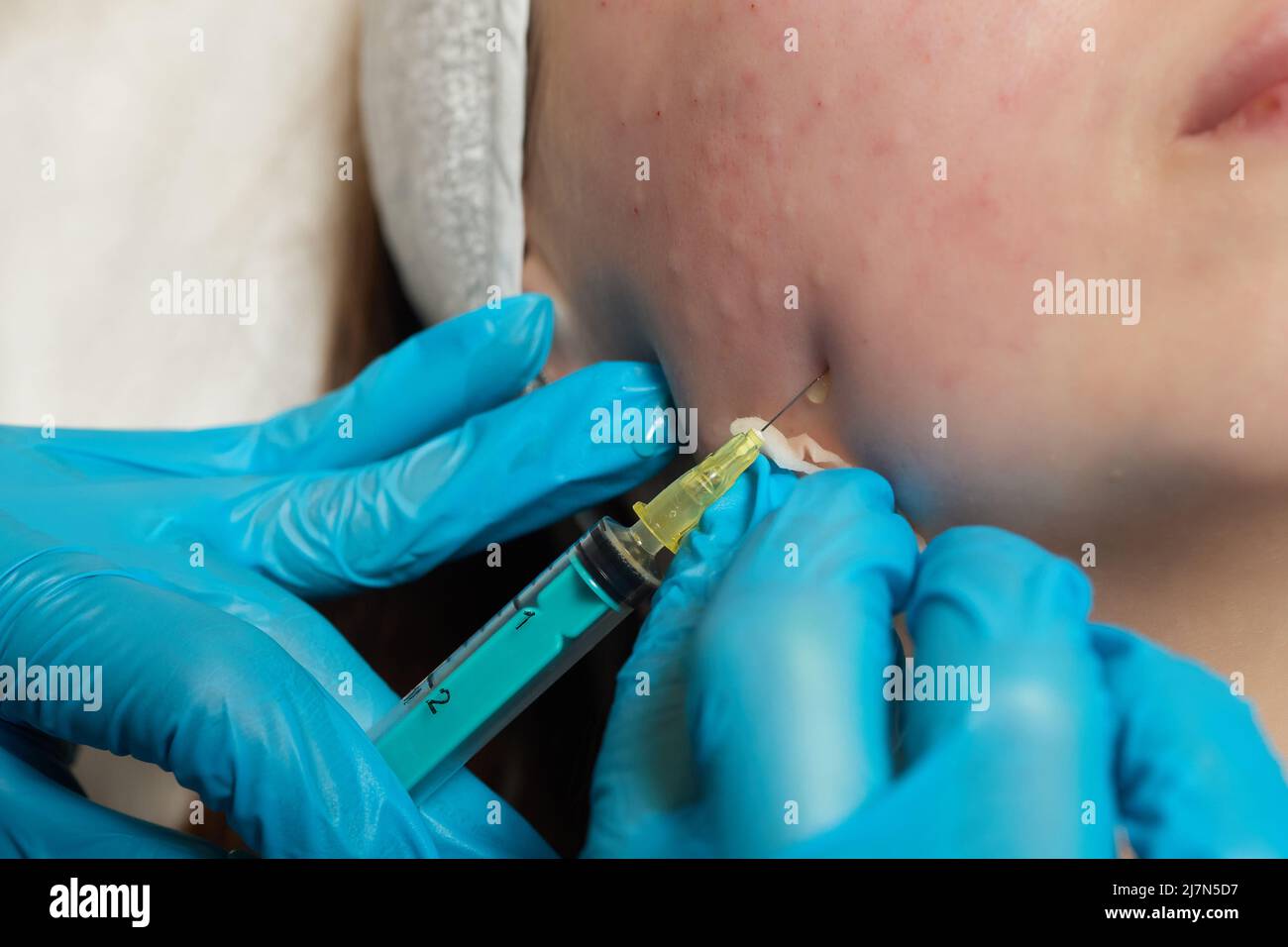 Siringa con plasma sanguigno di un paziente in una mano di un cosmetologo per un plasmolifting della pelle del viso di una donna. Plasma terapia, il ripristino delle cellule della pelle Foto Stock