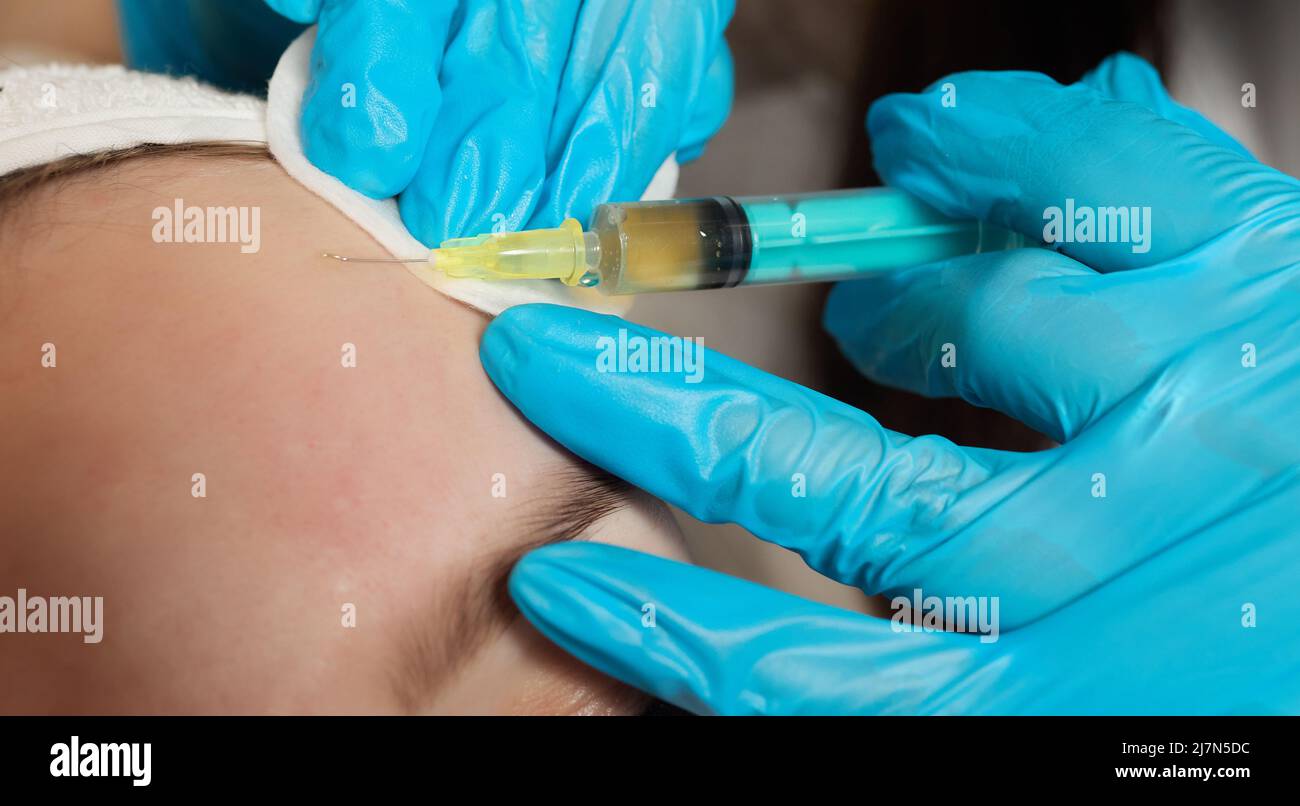 Siringa con plasma sanguigno di un paziente in una mano di un cosmetologo per un plasmolifting della pelle del viso di una donna. Plasma terapia, il ripristino delle cellule della pelle Foto Stock