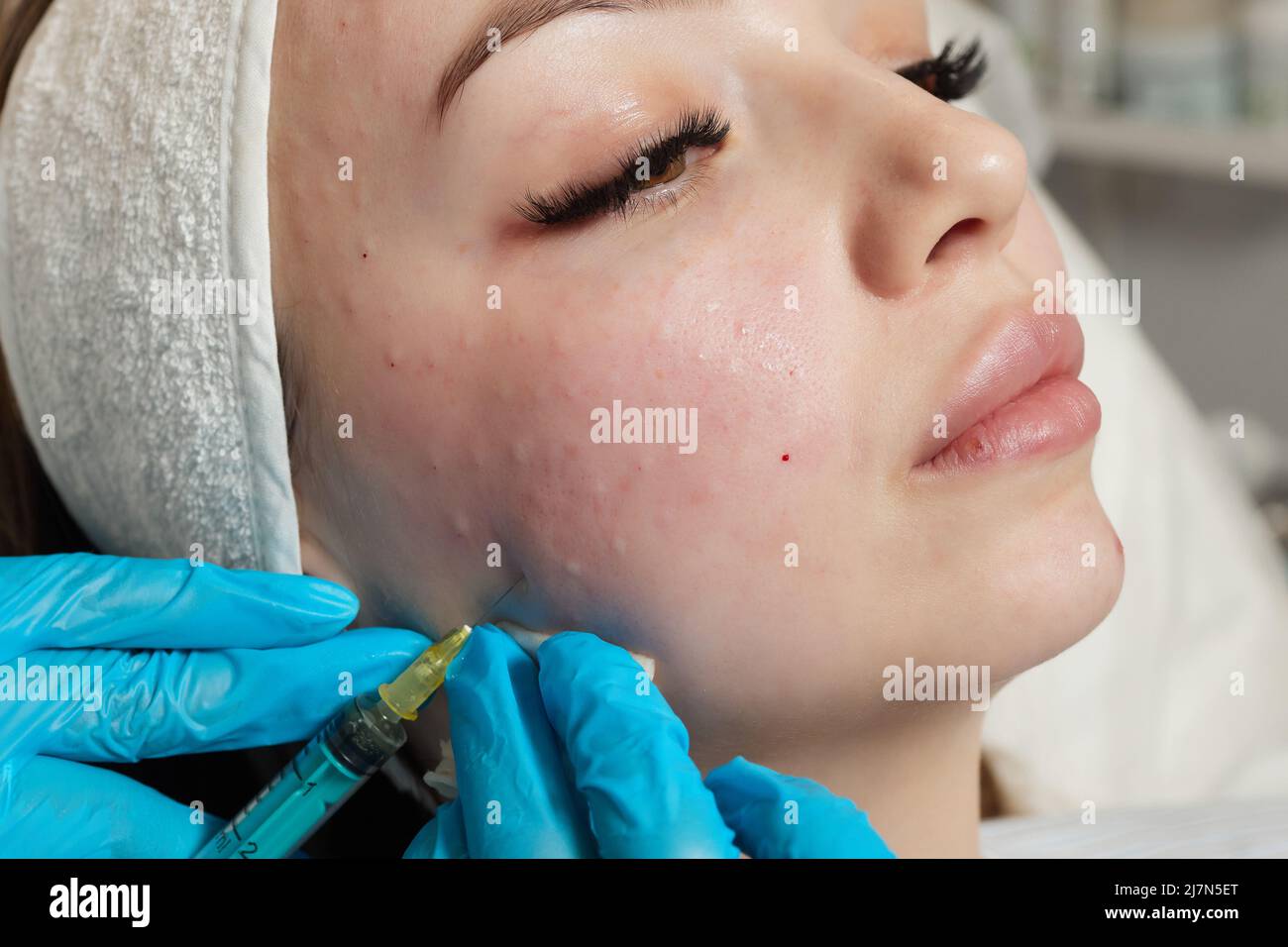 Siringa con plasma sanguigno di un paziente in una mano di un cosmetologo per un plasmolifting della pelle del viso di una donna. Plasma terapia, il ripristino delle cellule della pelle Foto Stock