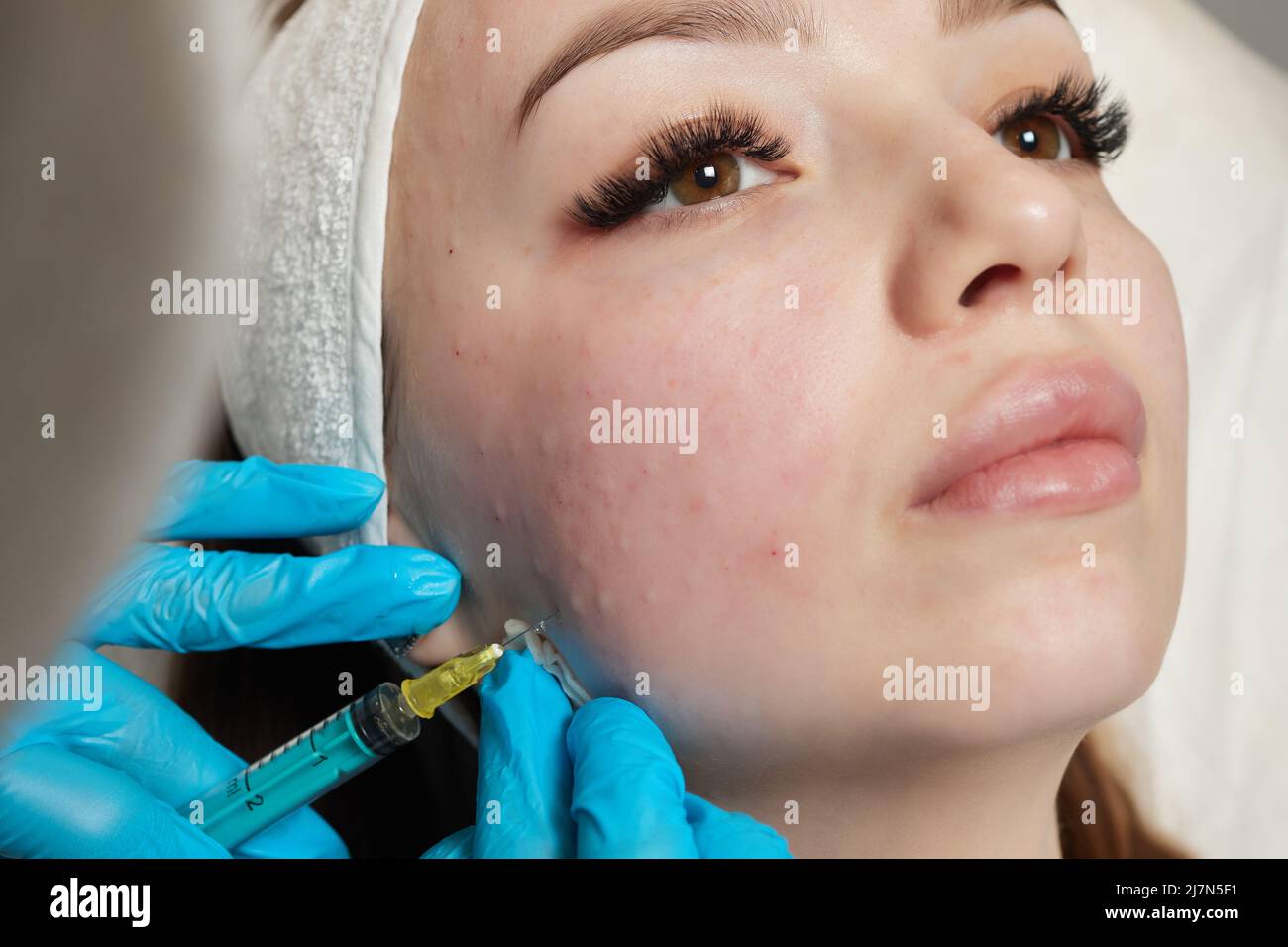 Siringa con plasma sanguigno di un paziente in una mano di un cosmetologo per un plasmolifting della pelle del viso di una donna. Plasma terapia, il ripristino delle cellule della pelle Foto Stock