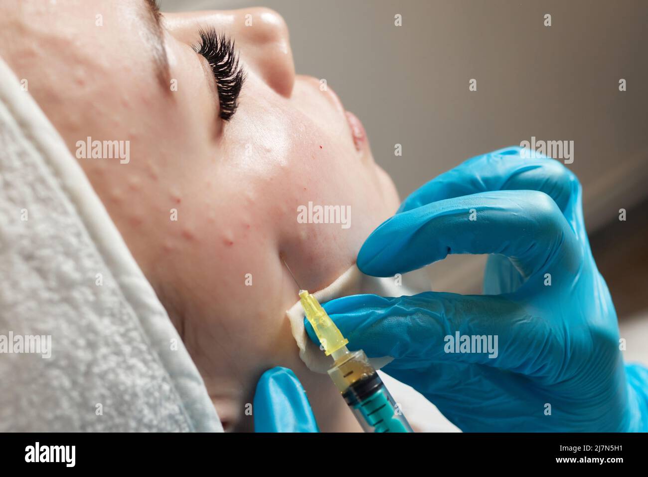 Siringa con plasma sanguigno di un paziente in una mano di un cosmetologo per un plasmolifting della pelle del viso di una donna. Plasma terapia, il ripristino delle cellule della pelle Foto Stock