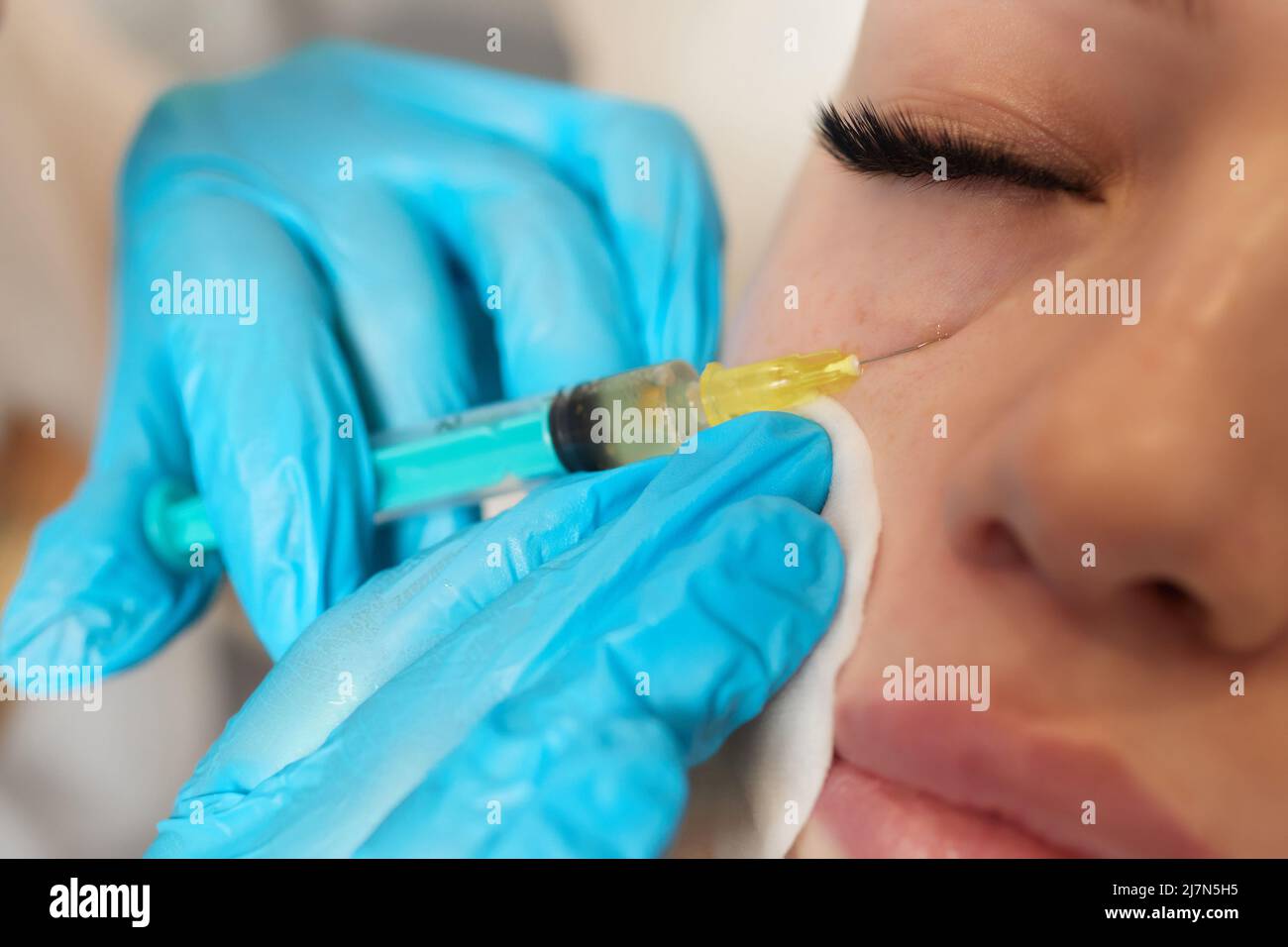 Siringa con plasma sanguigno di un paziente in una mano di un cosmetologo per un plasmolifting della pelle del viso di una donna. Plasma terapia, il ripristino delle cellule della pelle Foto Stock