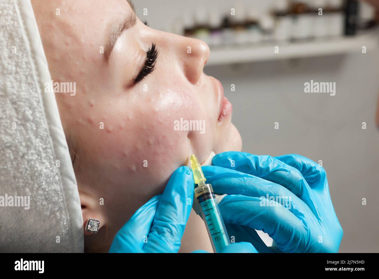 Siringa con plasma sanguigno di un paziente in una mano di un cosmetologo per un plasmolifting della pelle del viso di una donna. Plasma terapia, il ripristino delle cellule della pelle Foto Stock