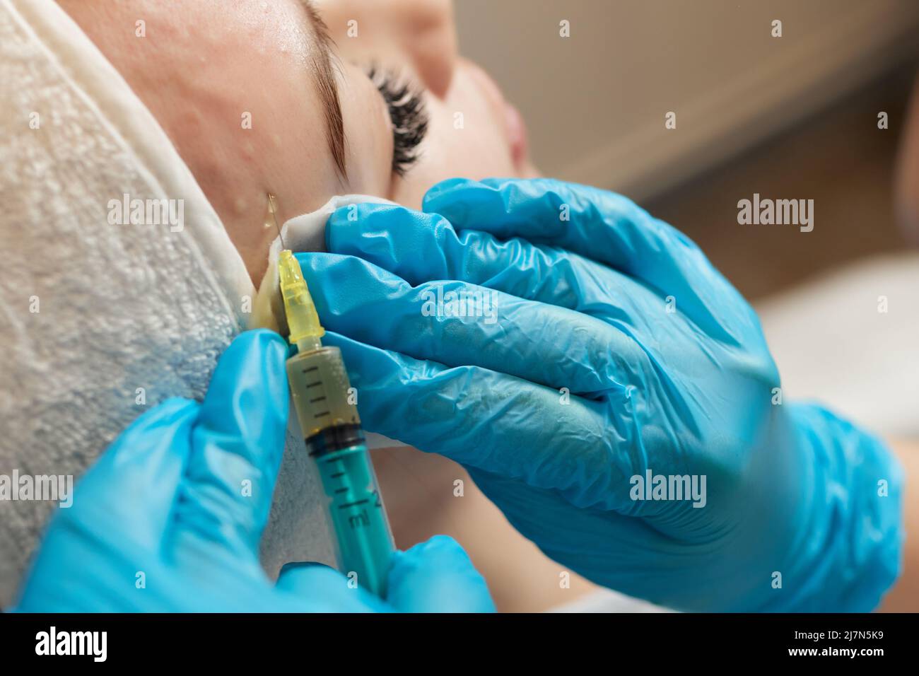 Siringa con plasma sanguigno di un paziente in una mano di un cosmetologo per un plasmolifting della pelle del viso di una donna. Plasma terapia, il ripristino delle cellule della pelle Foto Stock