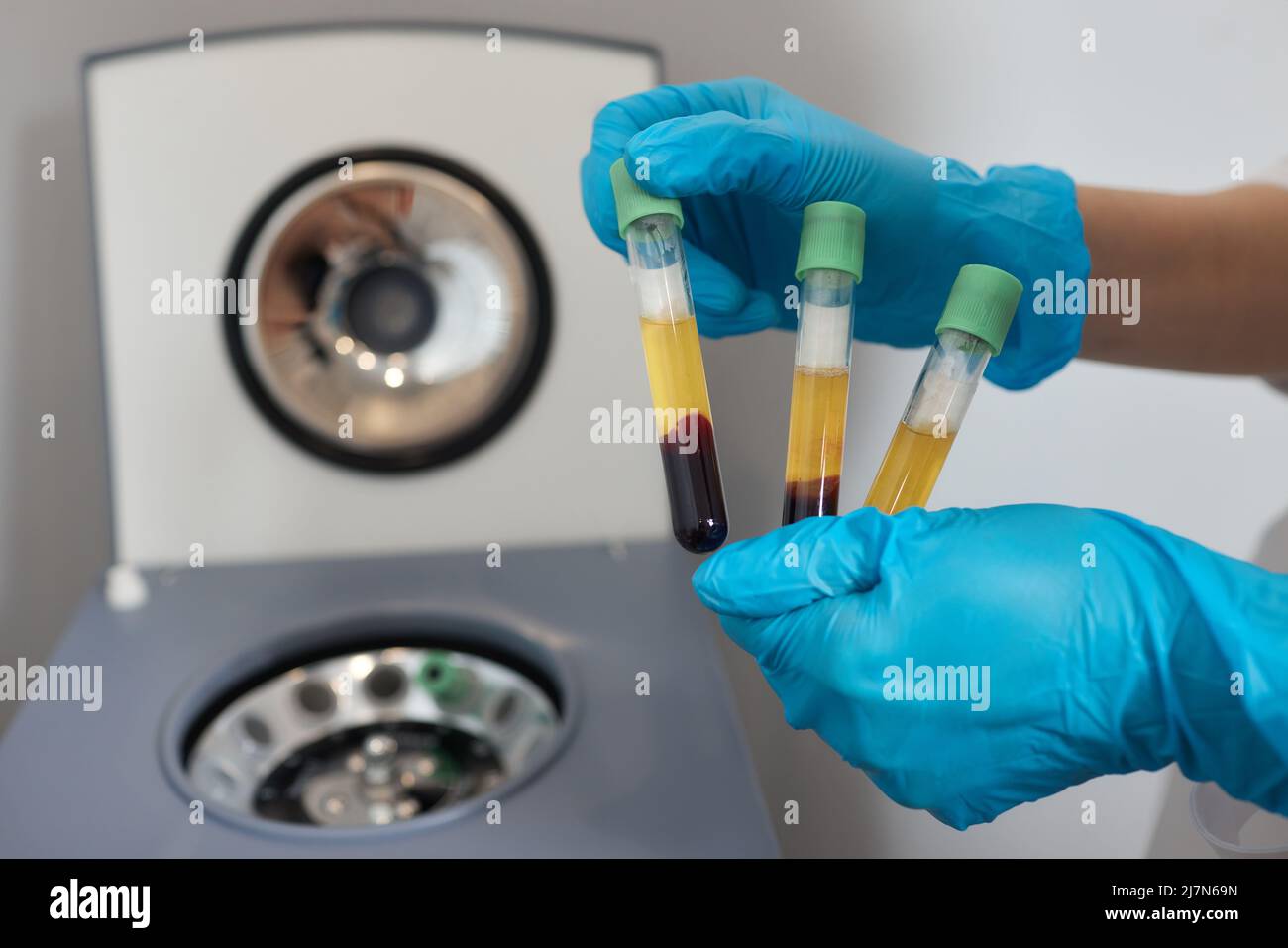 Preparazione del plasma ricco di piastrine. Plasma in siringa. Centrifugare Foto Stock