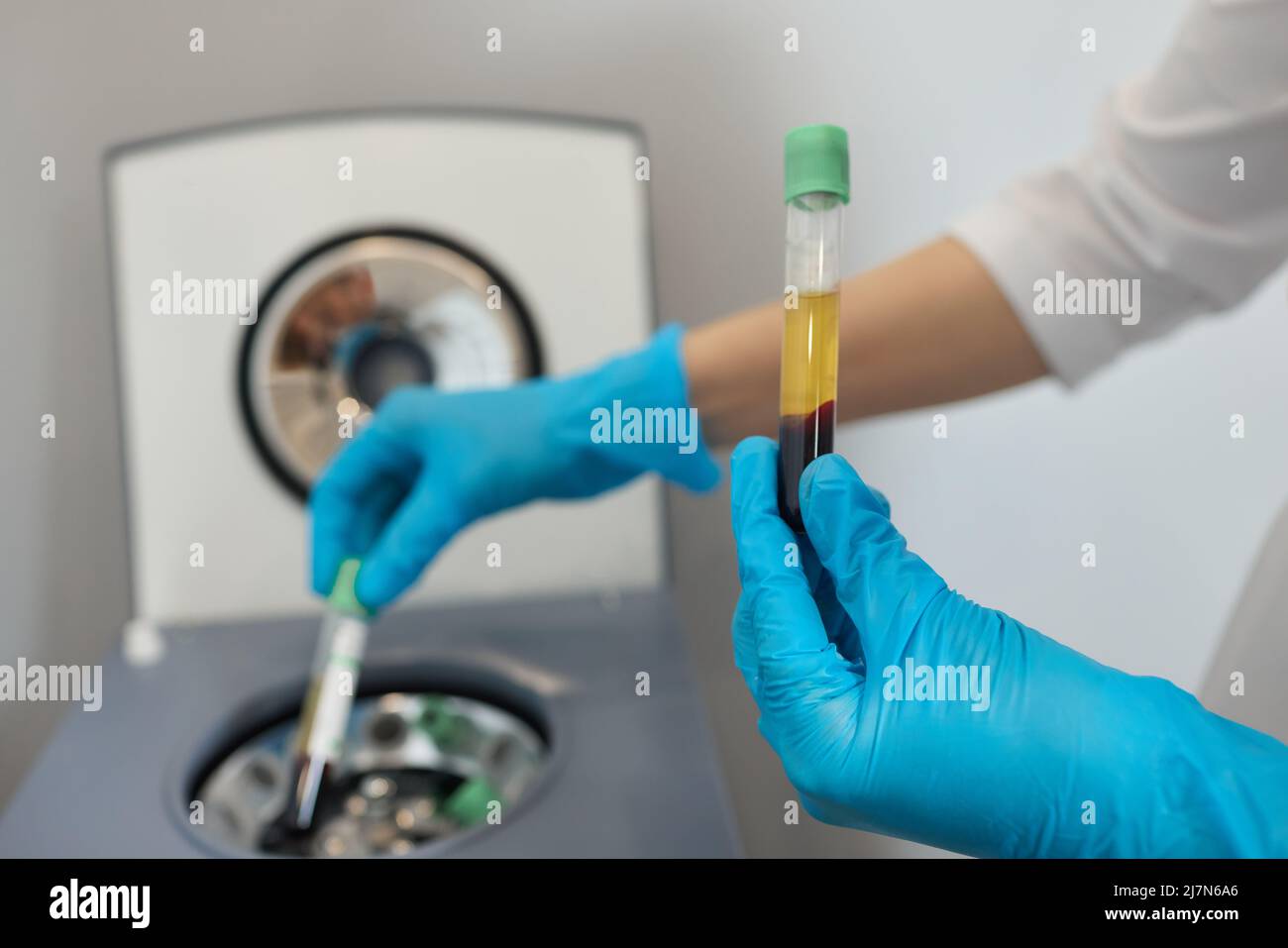 Preparazione del plasma ricco di piastrine. Plasma in siringa. Centrifugare Foto Stock