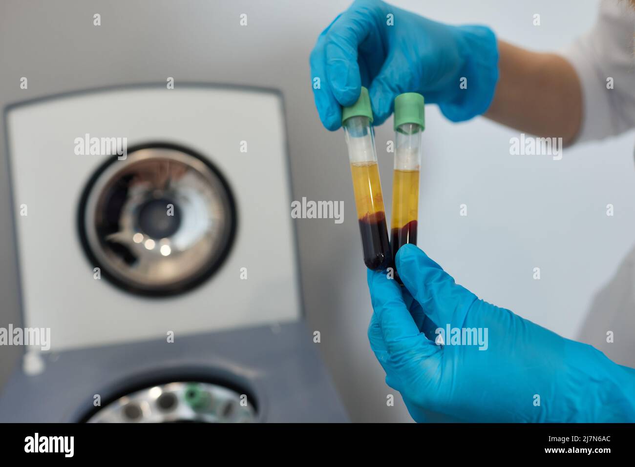 Preparazione del plasma ricco di piastrine. Plasma in siringa. Centrifugare Foto Stock