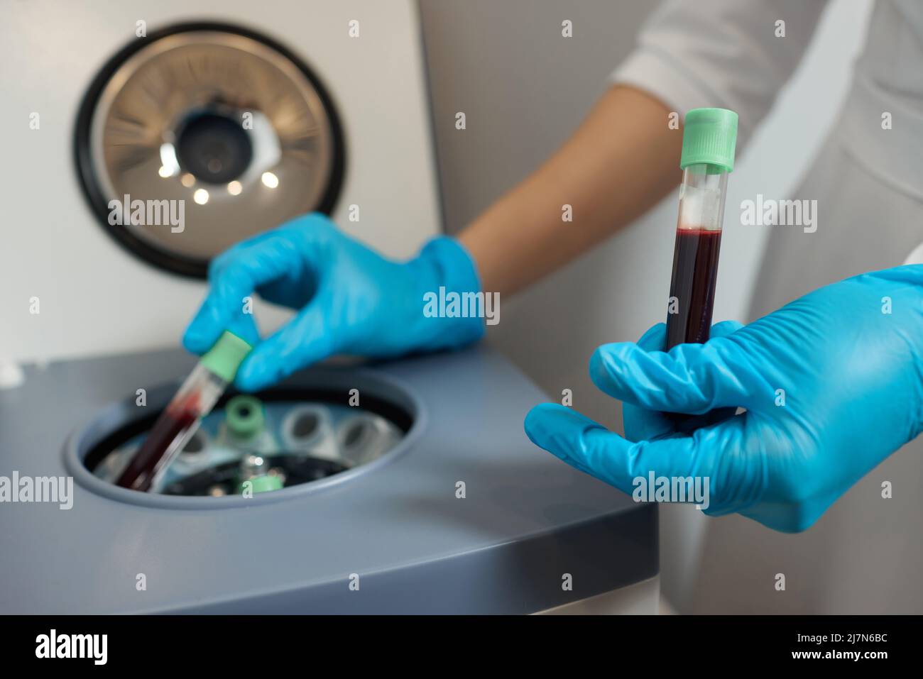 Preparazione del plasma ricco di piastrine. Plasma in siringa. Centrifugare Foto Stock