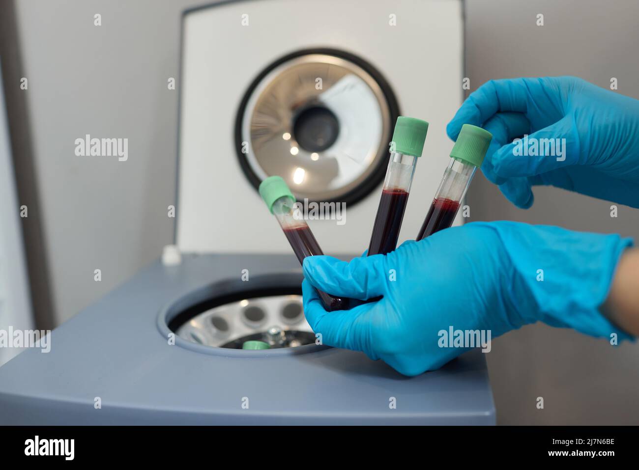 Preparazione del plasma ricco di piastrine. Plasma in siringa. Centrifugare Foto Stock