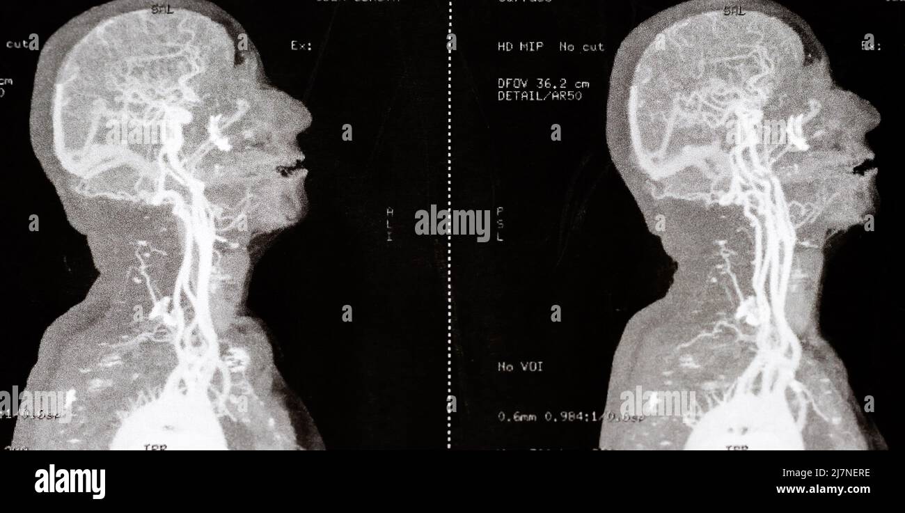 Foto ravvicinata di una RM con mezzo di contrasto del cranio e dei vasi sanguigni cerebrali di una persona sospettata di stenosi carotidea Foto Stock