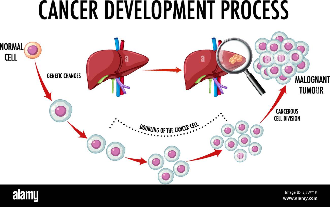 Diagramma che mostra l'illustrazione del processo di sviluppo del cancro Illustrazione Vettoriale