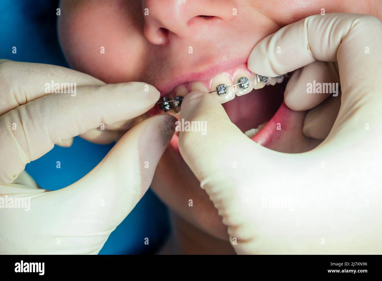 Bocca aperta dentale femmina con rinforzi in gel fissatore alla reception.Bracket System kappa close up Foto Stock