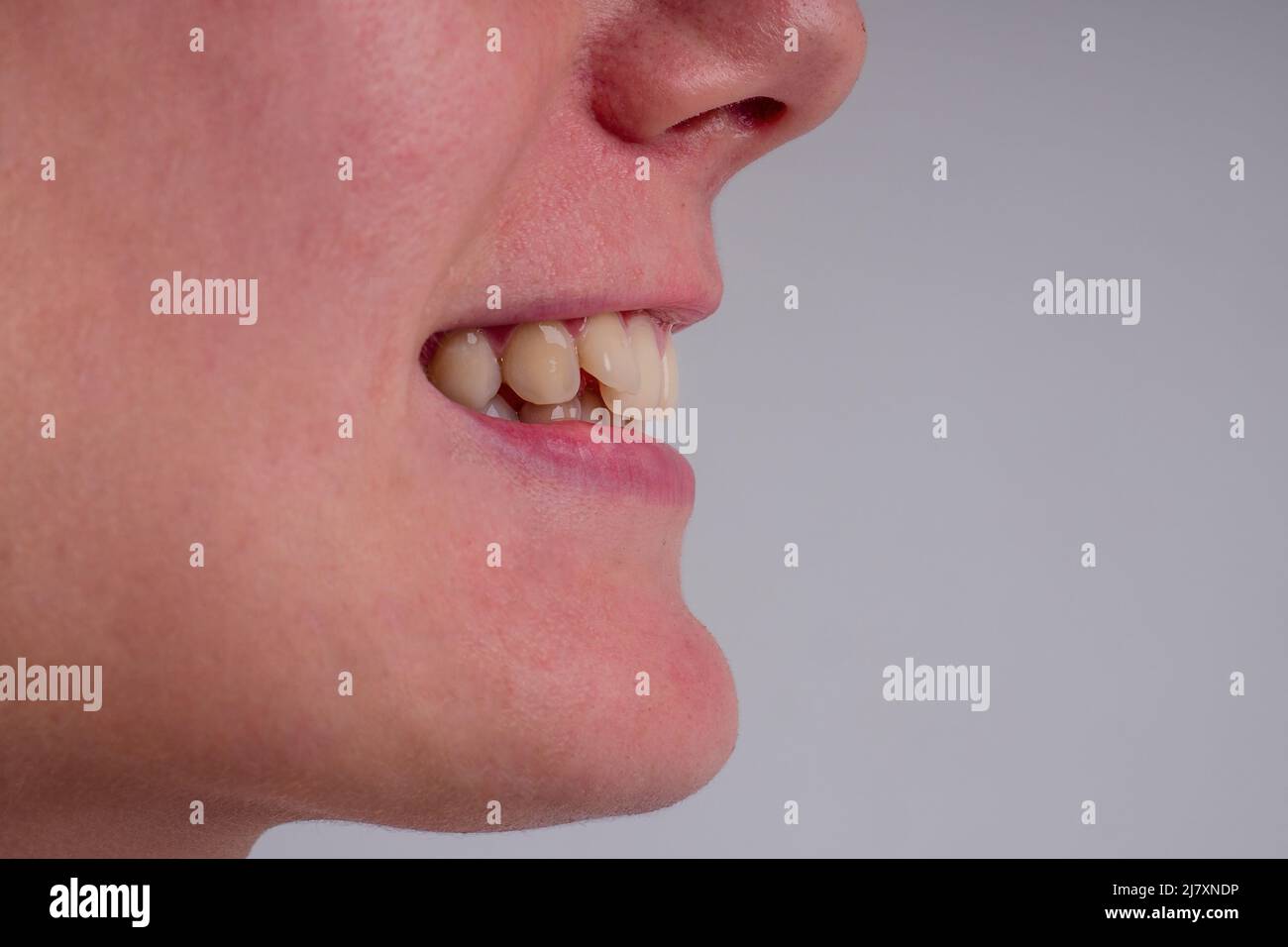 sorriso bianco con dente di curvatura della giovane donna sullo sfondo in studio Foto Stock