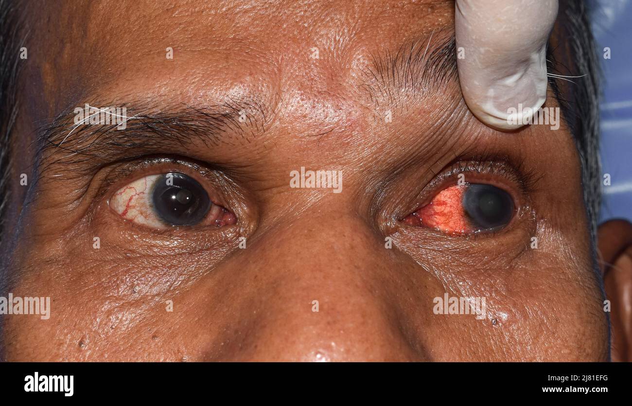 Infezione corneale o ulcera chiamata cheratite nel vecchio uomo asiatico. Foto Stock